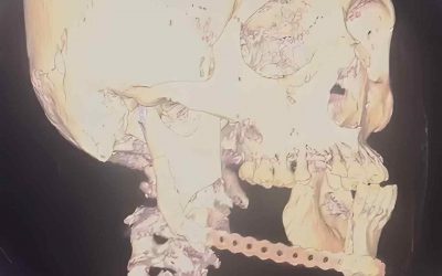 Historia de éxito en el IMSS Veracruz Sur