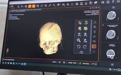 Exitosa cirugía de cráneo con malla de titanio a paciente y recupera calidad de vida