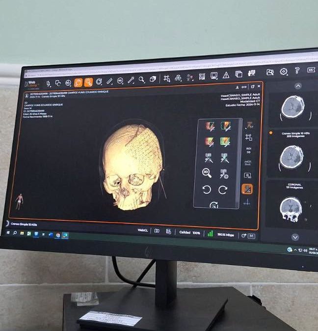 Exitosa cirugía de cráneo con malla de titanio a paciente y recupera calidad de vida